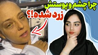 زردی چیست؟ | علائم و نشانه های یرقان در بزرگسالی| رویکرد بالینی به زردی