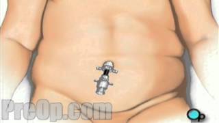 Gastric Bypass Laparoscopic Surgery PreOp® Patient Education Medical Video