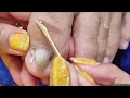 vlog 248 dry skin ingrown removal pedicure 153