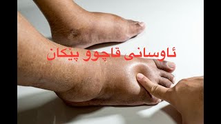 ️کێشەی ئاوسانی پێکانو قاچەکان