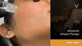 MicroGold Infusion Therapy | Musk Clinic