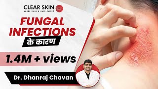 Fungal Infection Causes In Hindi (फंगल इन्फेक्शन के कारण) | ClearSkin, Pune