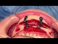 Revision chin Augmentation by removing implant and performing vertical and horizontal Genioplasty