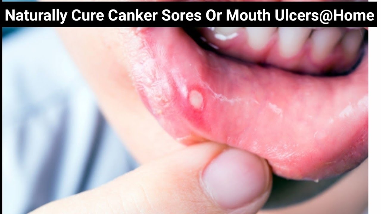 Canker Sores|How To Get Rid Of Canker Sores Or Mouth Ulcers;Naturally ...