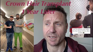 Hair Transplant Number 2 for CROWN @ Dr Cinik. Turkey, One YEAR Later!