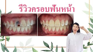 รีวิวครอบฟันหน้า