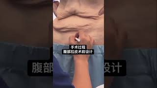 😭減重75公斤後 卻留下鬆弛的肚皮？#媽媽日常 #減肥 #瘦肚子 #推薦