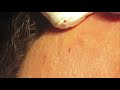 blackheads extractions on happy 7