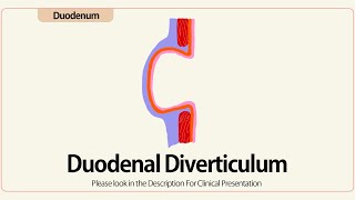 Linear EUS: Duodenal diverticula