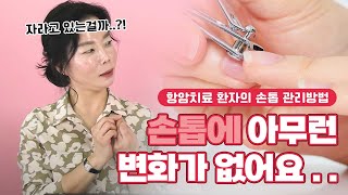 손톱에 아무 변화가 없는데 전 괜찮은 건가요? _ 항암치료 환자의 손톱 관리방법에 대해