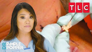 The BEST Pimple Pops | Dr. Pimple Popper | TLC
