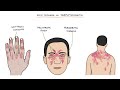 Understanding Myositis (Polymyositis and Dermatomyositis)