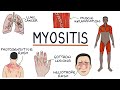 Understanding Myositis (Polymyositis and Dermatomyositis)