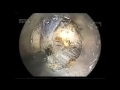 should the integrity of mucosa be considered in endoscopic resection of gastric submucosal tumors