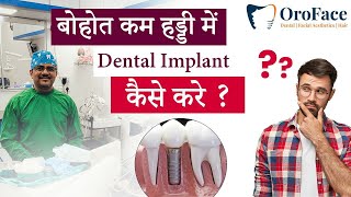 बोहोत कम हड्डी मे Dental Implant कैसे करे?