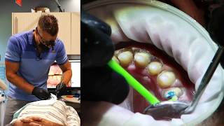 Full Mouth Dental Restoration - LIVE Treatment - Part II