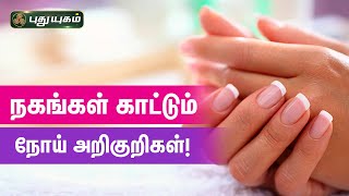 நகங்கள் காட்டும் நோய் அறிகுறிகள்! Dr.M.S.UshaNandhini | PuthuyugamTV