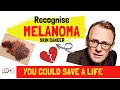 What is Melanoma | Skin cancer | How to recognise it and prevent it