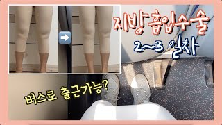 [지방흡입vlog] 허벅지 지흡 수술 2~3일차 후기/🚌출근가능?