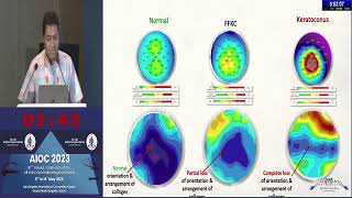 AIOC 2023   GP56   topic Prof  Dr Rohit Shetty Collagen Imaging and its role in refractive surgery p