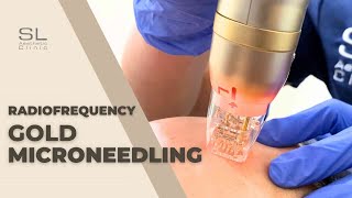 RF Gold Microneedling: Your Face Lift and Rejuvenation Solution