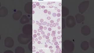 Hereditary Spherocytosis and mutations in 60 seconds #pathagonia