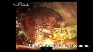 Robotic Resection of an Anterior Mediastinal Mass