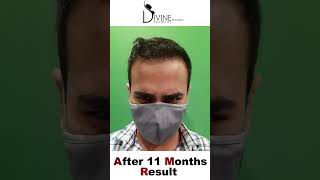 Hair Transplant Results (Case Study) After 11 Months
