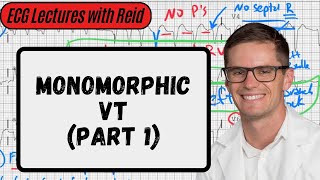 Monomorphic Ventricular Tachycardia | Day 21 ECG Challenge