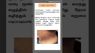 கழுத்தில் உள்ள கருமை மறைய#shortsfeed #shortvideo #shorts #shortsviral #beauty #beautytips #ytshorts