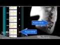 Vertebral Motion Analysis for testing cervical spine motion at Spine Nevada, Reno, Sparks, Carson