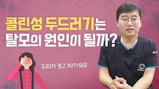 콜린성 알레르기가 탈모를 일으킬까?