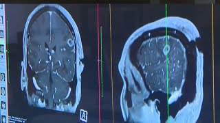 Penn Medicine Treating Glioblastoma Using Patient's Own Immune System