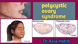 polycystic ovary syndrome|PCOS|polycystic ovary kia Hoti hay