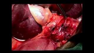 Right Liver Resection. - Dr Sharad  Desai, MGCH