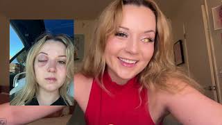 How I Lost My Eye