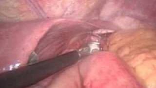 Laparoscopic Sleeve with Second-Stage Roux-en-Y Gastric Bypass