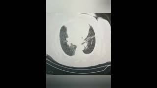 LUNG on CT