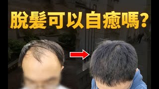 【脫髮治療】脂溢性脫髮能夠自愈嗎？治療脫髮的3種有效方法！丨植髮醫生李丙雙