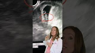 Can you HEAR the Heartbeat on a 7 Week Ultrasound?