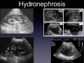 urologic stone disease management of kidney stones in the emergency department