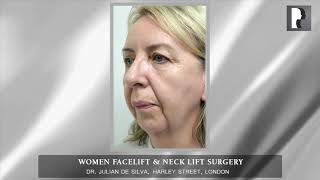 Natural Women Facelift \u0026 Neck Lift Surgery in London