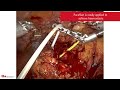 using purastat for haemostasis during a partial nephrectomy