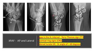 Anatomy of Scapholunate Ligament of the wrist