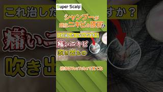 【1分でわかる】頭皮ニキビと吹き出物が出来る原因と正しい対策を発毛のプロが解説