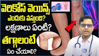 Varicose Veins - Symptoms and Causes : | వెరికోస్ వెయిన్స్ || Dr . Ajay || iD Health  360