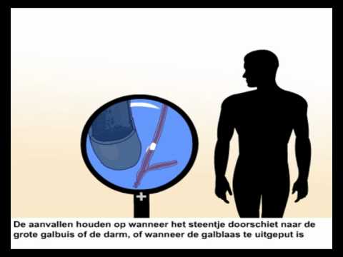 Galstenen - Symptomen En Verwijderen - YouTube