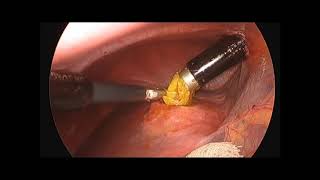 Laparoscopic Cyst Deroofing for Liver Hydatid Cyst with Cystobiliary Communication