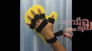 ตอนที่ 52: อุปกรณ์ดามกันนิ้วมืองอ Type 2 (Palmar Correction Splint Type 2)