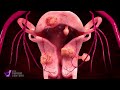 watch how ufe uterine fibroid embolization works